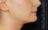 Chin Liposuction - Lower Facial Rejuvenation