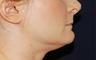 Chin Liposuction - Lower Facial Rejuvenation