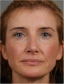 45 year old female with a nasal deformity after rhinoplasty with obstruction requesting revision surgery