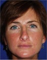 45 year old female with a nasal deformity after rhinoplasty with obstruction requesting revision surgery