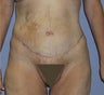 Extended abdominoplasty post gastric bypass