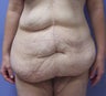 Extended abdominoplasty post gastric bypass