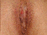 Labiaplasty