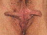 Labiaplasty