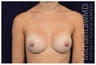 Breast Augmentation