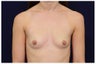 Breast Augmentation