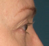 Ulthera