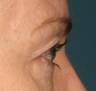 Ulthera