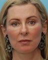 Cheek Augmentation Using Juvederm