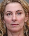Cheek Augmentation Using Juvederm