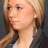 Chin Implant