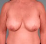 Female Breast Lift
