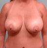 Female Breast Lift