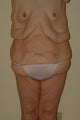 Tota body contouring