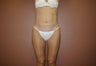 Liposuction of Inner and Outer Thighs and Abdomen