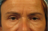 Upper eyelid and festoon treatment