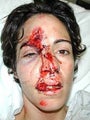 Female Biking Accident