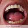 Male with only 4 teeth got Full upper porcelain bridge and ridge augmentation