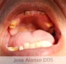 Male with only 4 teeth got Full upper porcelain bridge and ridge augmentation