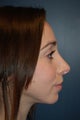 Nose Surgery