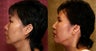 Asian Rhinoplasty