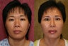 Asian Rhinoplasty