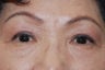 Asian Upper Lid Lift