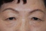 Asian Upper Lid Lift