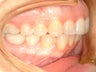 overbite