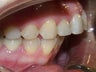 overbite
