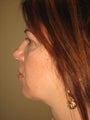 45 year old female before and after SmartLipo of the neck