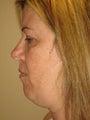 45 year old female before and after SmartLipo of the neck