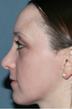 Acne Treatment with Fraxel Repair
