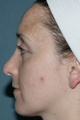 Acne Treatment with Fraxel Repair