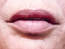 Injectable Fillers