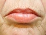 Injectable Fillers