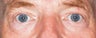 Male Eyelid Surgery
