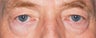 Male Eyelid Surgery