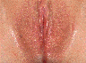 Vaginoplasty