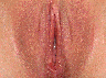 Vaginoplasty