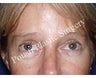 Forehead Lift