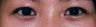 Bilateral Asian Eyelid Surgery