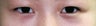Bilateral Asian Eyelid Surgery