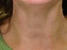 Botox