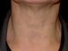 Botox