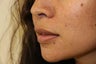 Upper Lip Lift - Before and 1 Year After