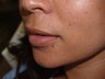 Upper Lip Lift - Before and 1 Year After