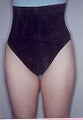 Tumescent Liposuction