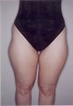 Tumescent Liposuction