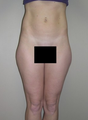 Liposuction